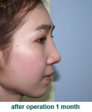 plastic_surgery_augmentation_rhinoplasty